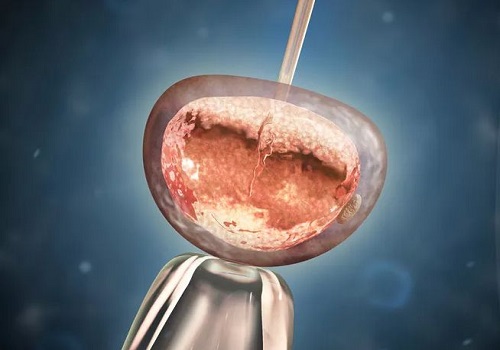 泰国试管放2个胚胎的成活率有多高？